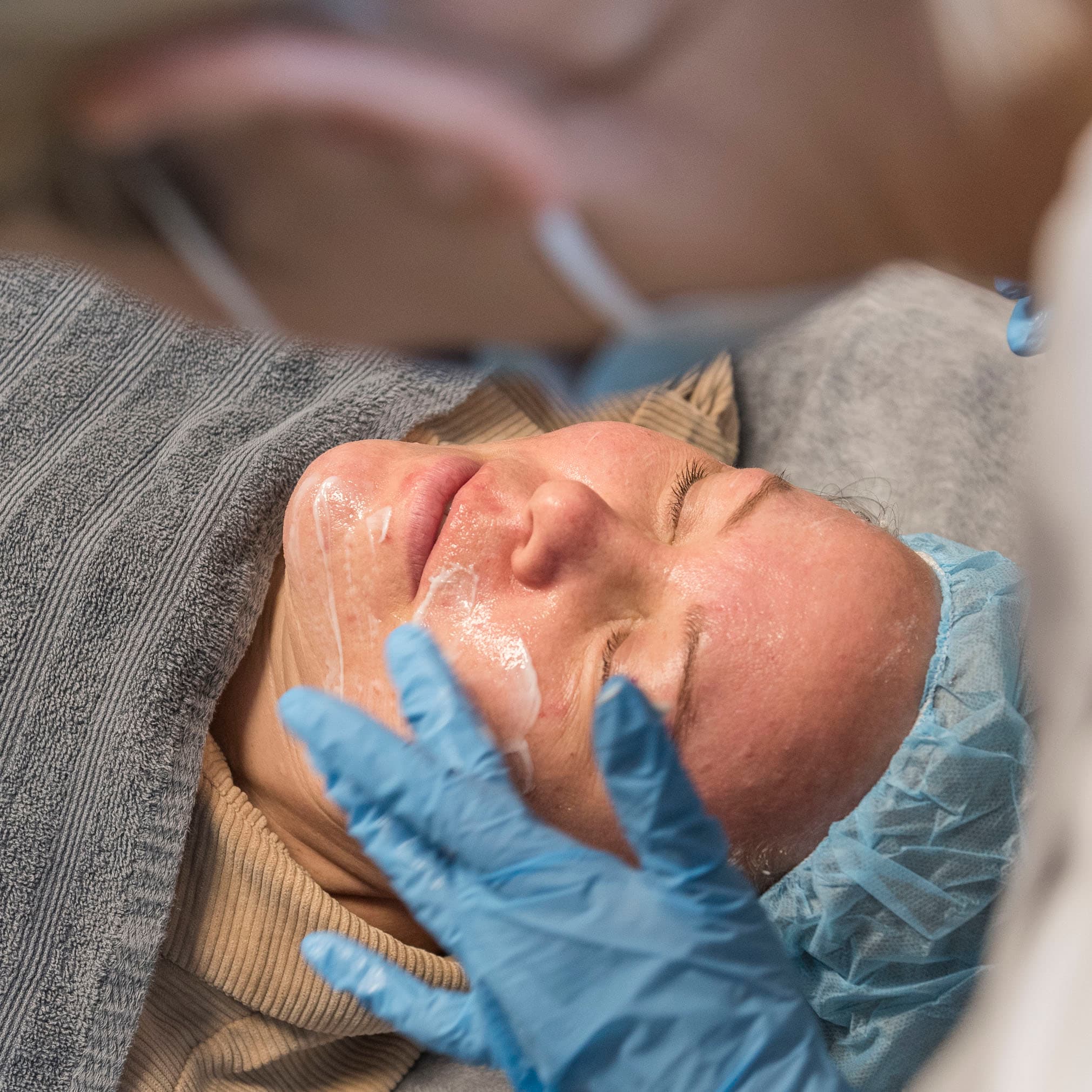 Rosacea-behandling